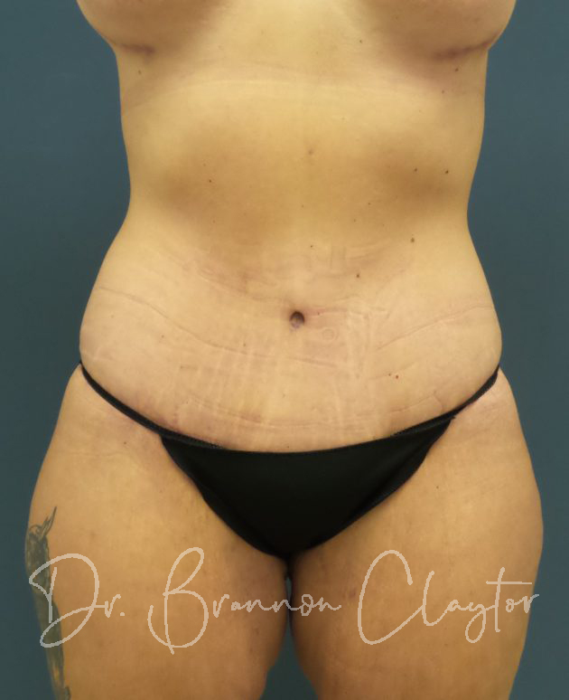 Reverse Upper Modified Lower Abdominoplasty Photo Gallery