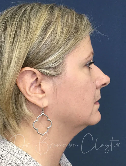 neck-smartlipo-45675c-before