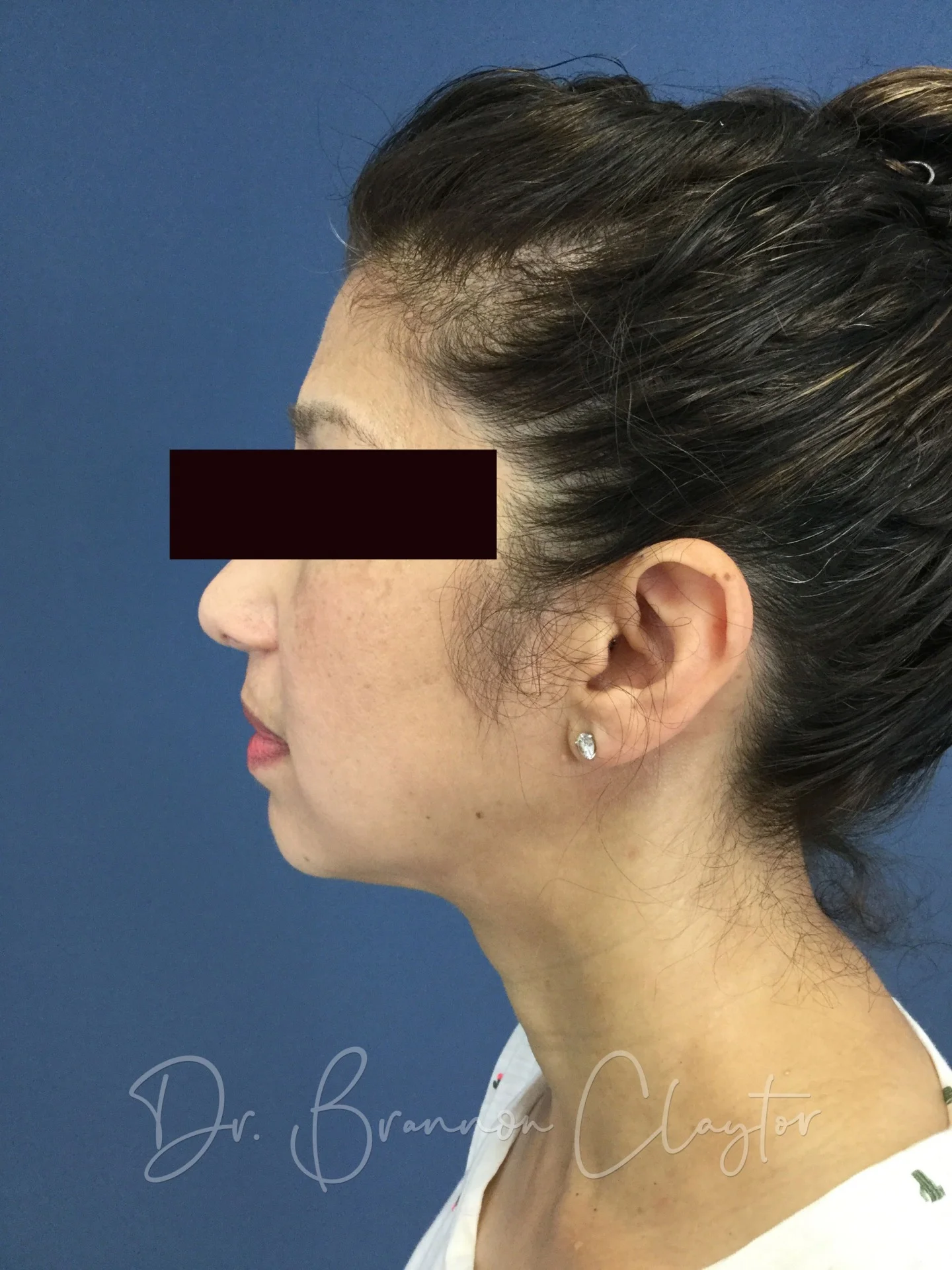 Skin Tightening Philadelphia Laser Surgery Main Line - Titan Laser