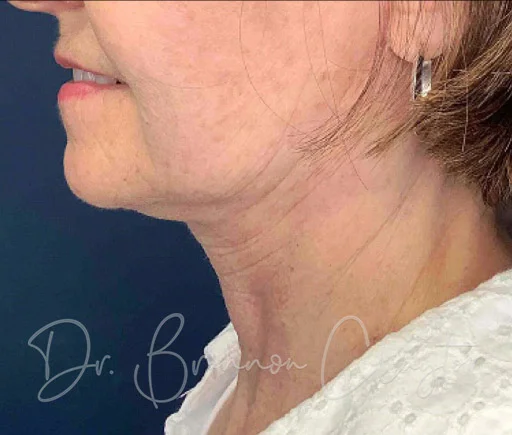 lower-facelift-neck-lift-100c-after