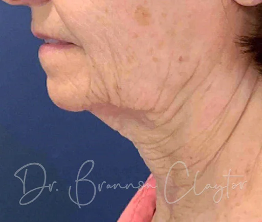 lower-facelift-neck-lift-100c-before