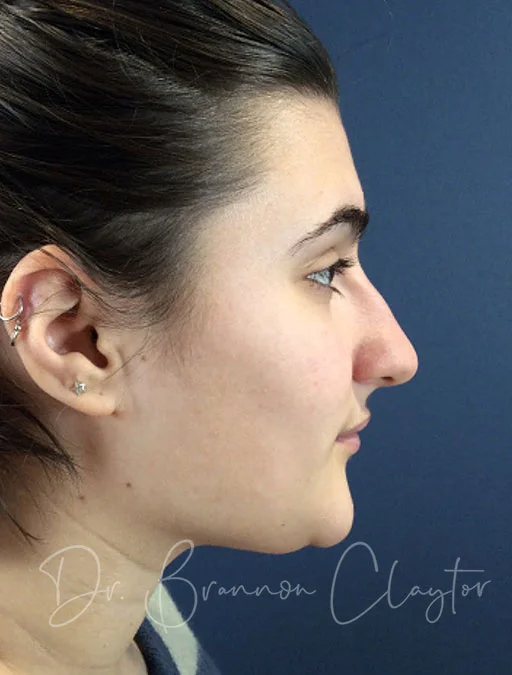 rhinoplasty-47301c-before