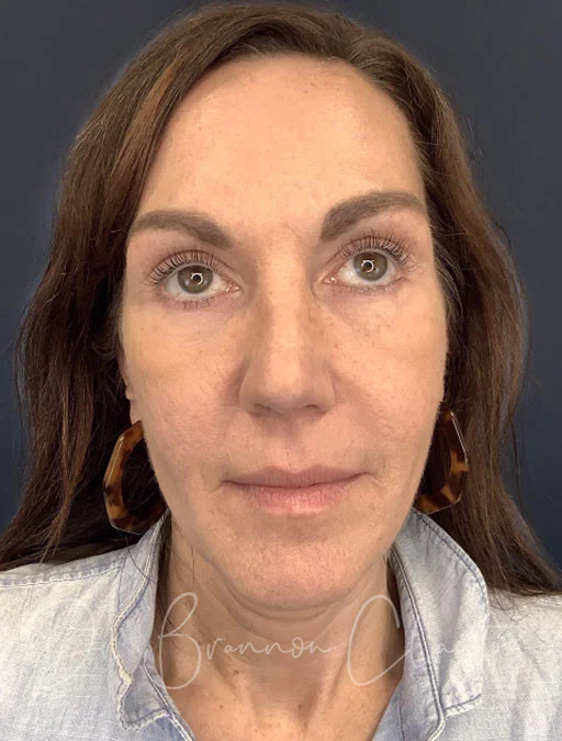 rhinoplasty-47778a-after