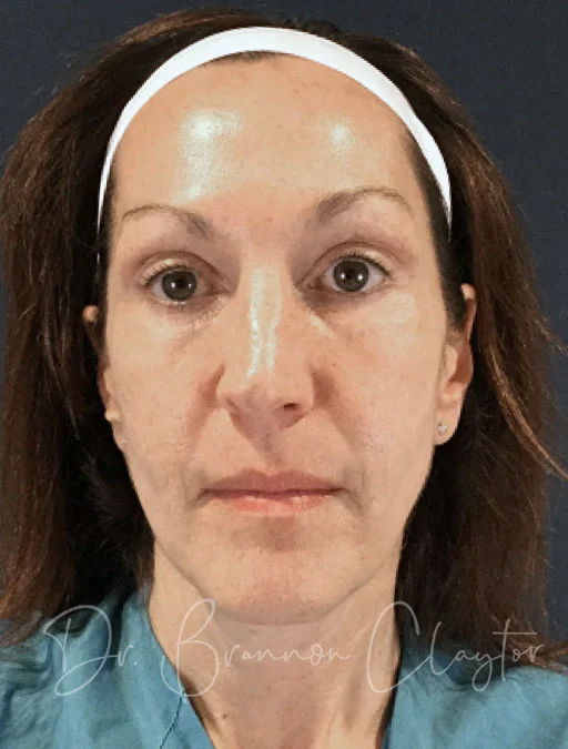 rhinoplasty-47778a-before