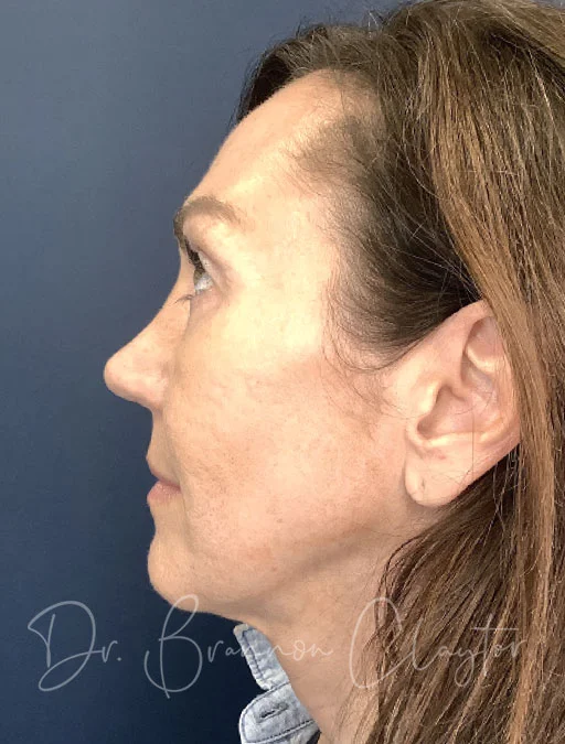 Rhinoplasty