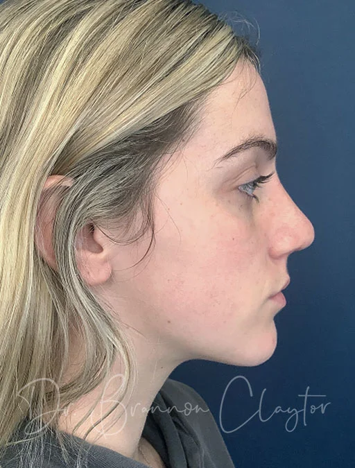 rhinoplasty-47914c-after