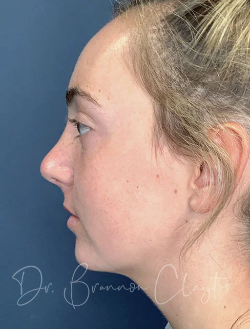 rhinoplasty-48305c-after