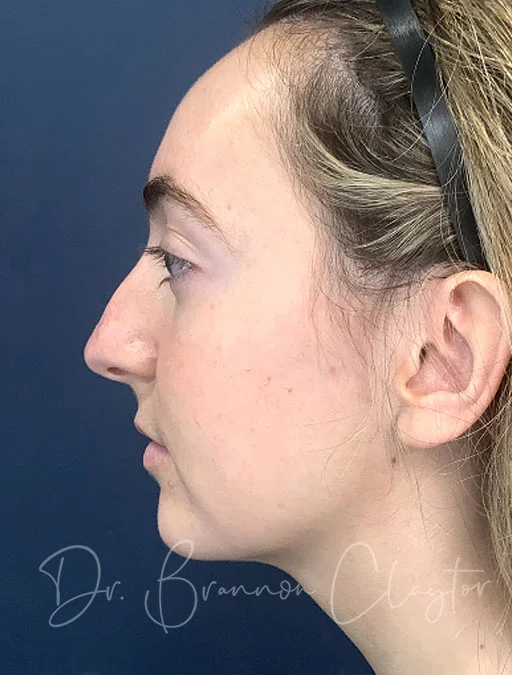 rhinoplasty-48305c-before