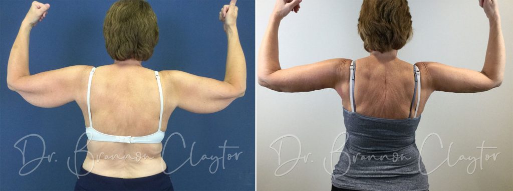 Before and after arm lift surgery with Philadelphia plastic surgeon Dr. Claytor