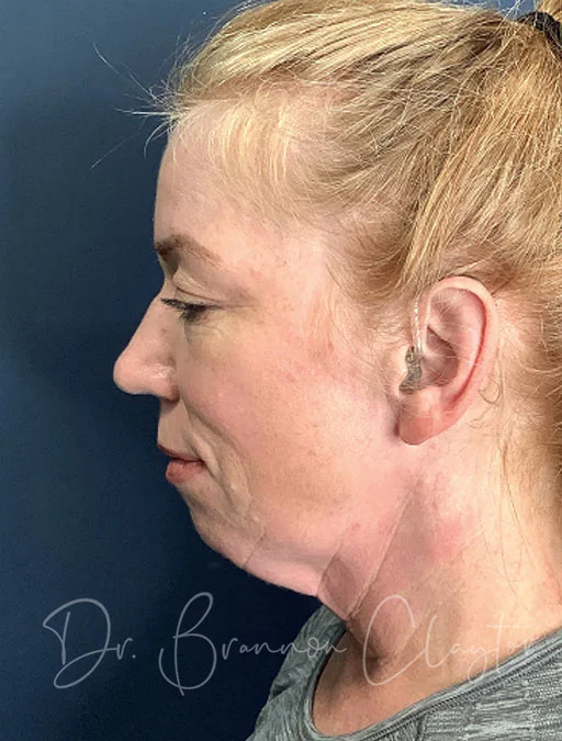 MyEllevate Neck Lift with Smart Liposuction