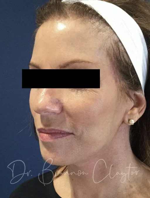 Facelift & Neck Liposuction