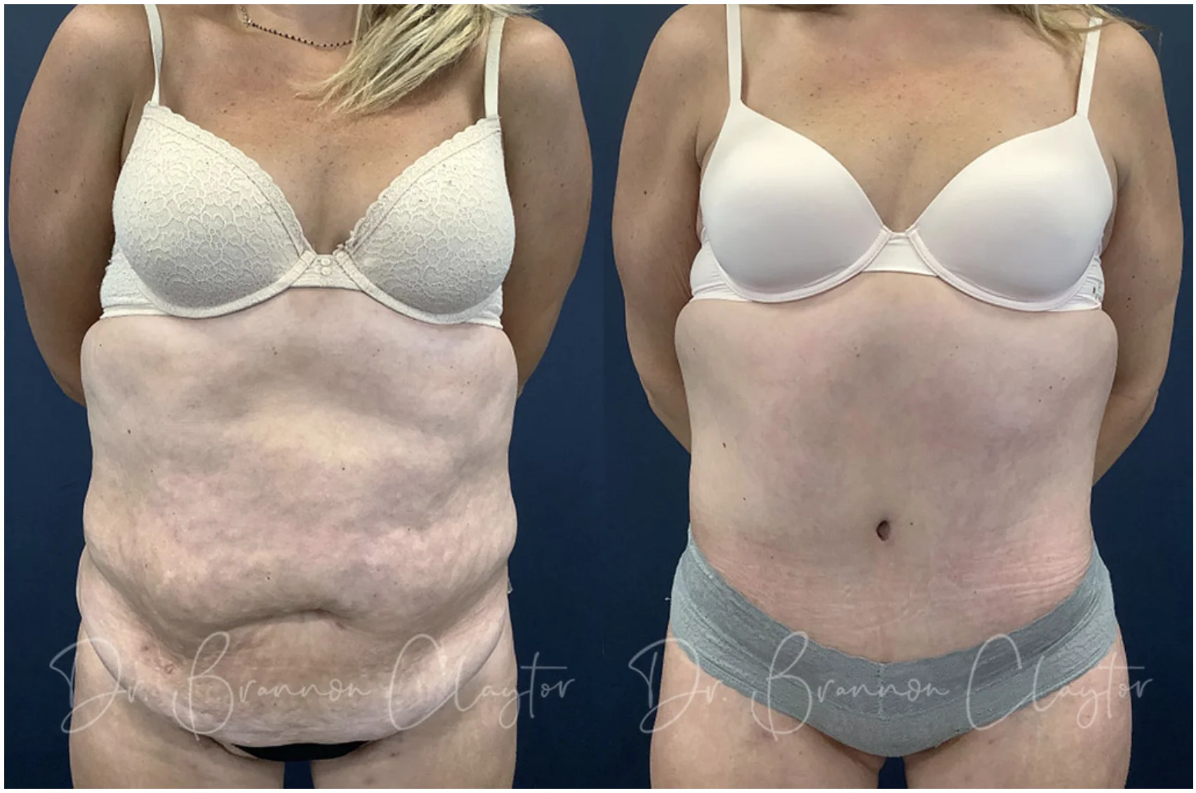 Drains after tummy tuck - for how long? - Power Plastic Surgery