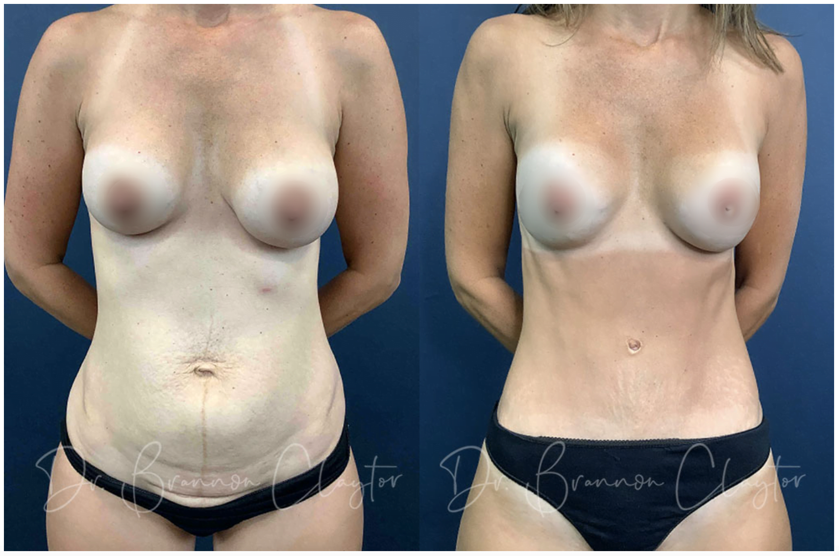 Dr. Claytor Tummy Tuck Patient 27