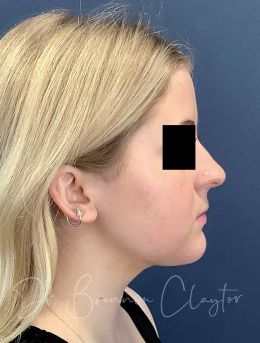 MyEllevate Neck lift with Neck Liposuction