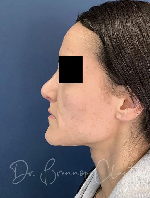 Rhinoplasty