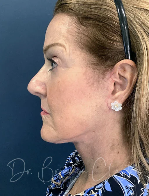 MyEllevate Neck lift