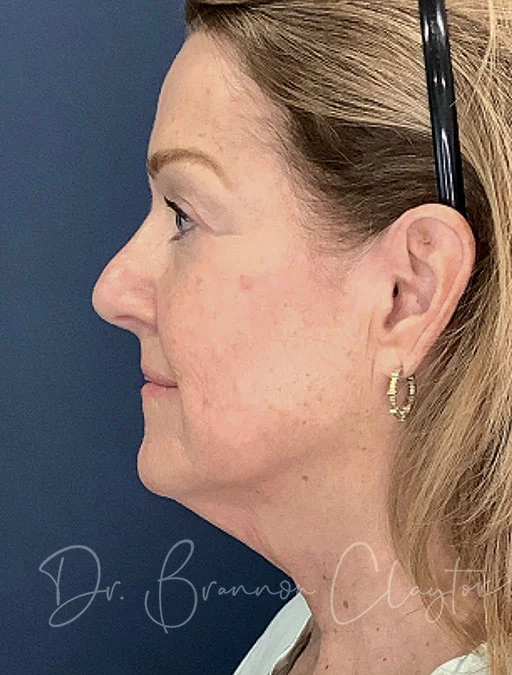 MyEllevate Neck lift