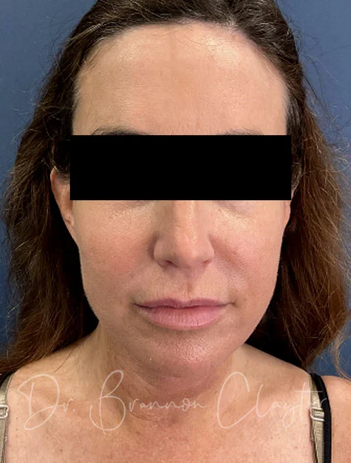 neck-lift-myellevate-43488a-after