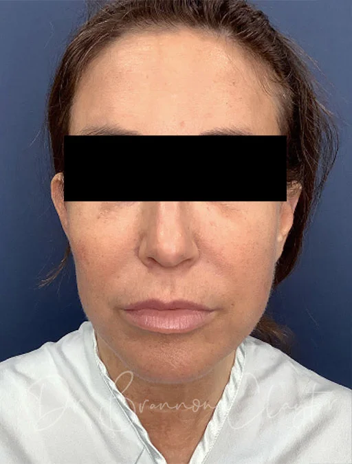 neck-lift-myellevate-43488a-before