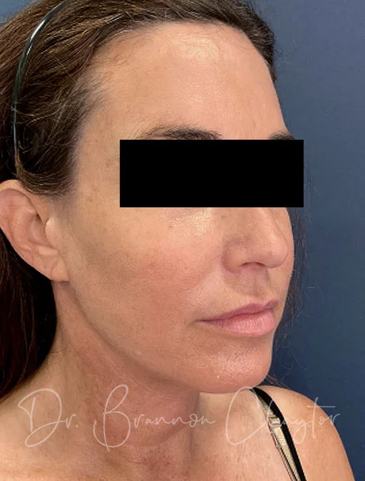 neck-lift-myellevate-43488b-after