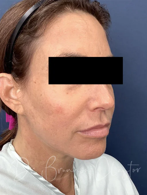 neck-lift-myellevate-43488b-before