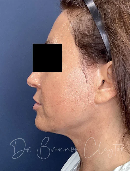 MyEllevate Neck lift