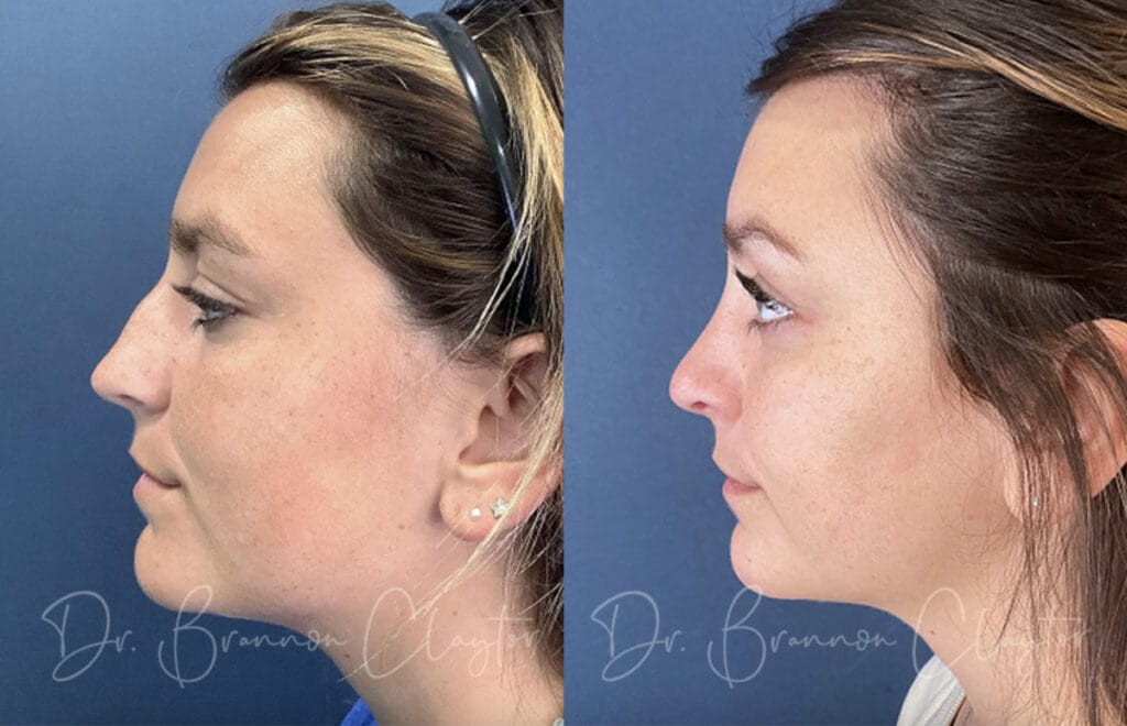 Before and after rhinoplasty with Philadelphia plastic surgeon Dr. Claytor