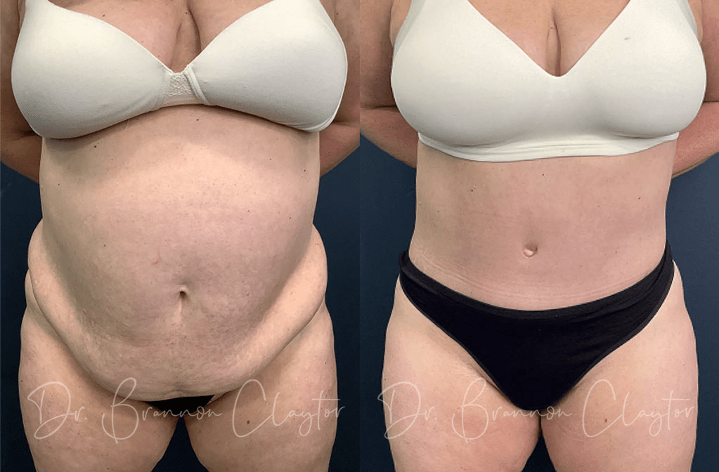 How Many Sizes Can You Lose With a Tummy Tuck?