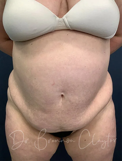 Asymmetrical abdomen after a tummy tuck - Hourglass Tummy Tuck