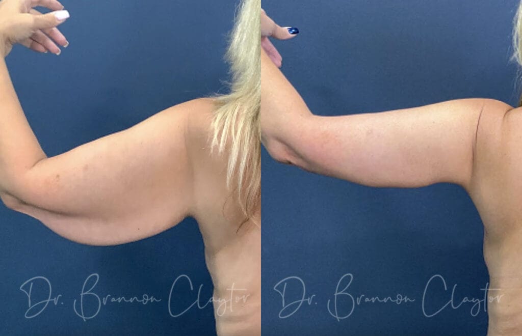 Before and after an arm lift with Philadelphia plastic surgeon Dr. Brannon Claytor