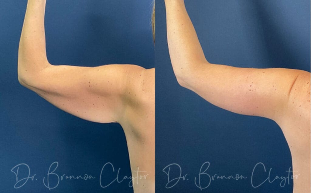 Before and after an extended arm lift with Dr. Claytor in Philadelphia