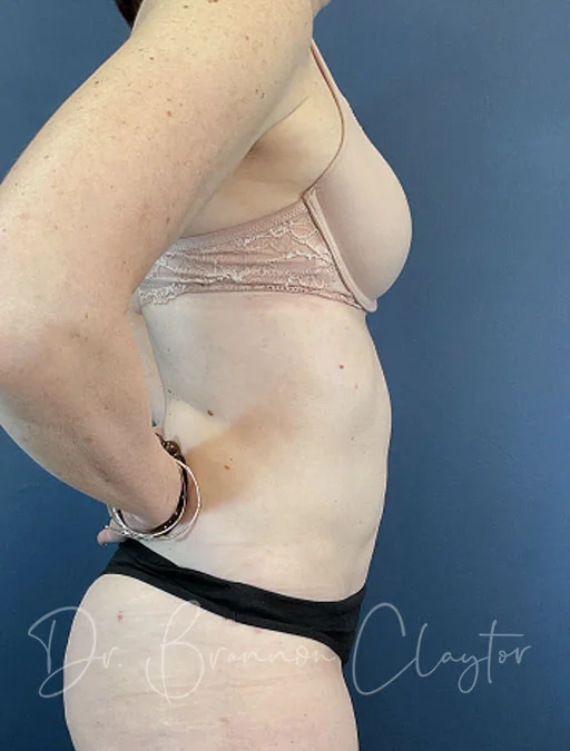 smart-liposuction-abdomen-flank-50417c-after-claytor