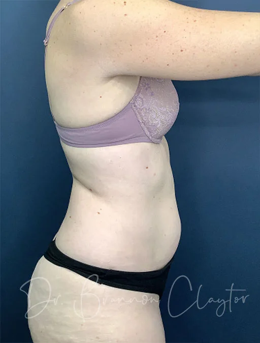 smart-liposuction-abdomen-flank-50417c-before-claytor