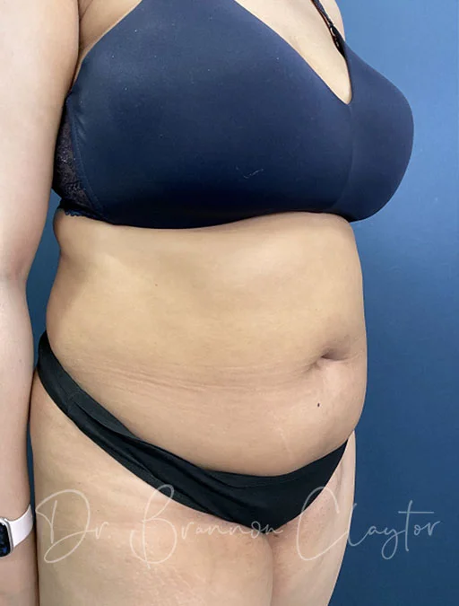 First Set of Large Implants November 2020 - Review - RealSelf