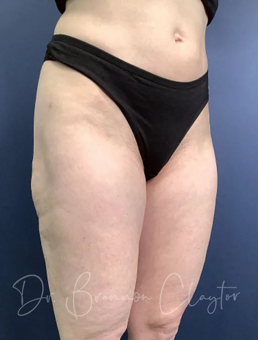 smart-liposuction-outer-thighs-47180b-after-claytor