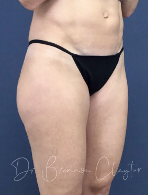 smart-liposuction-outer-thighs-47180b-claytor