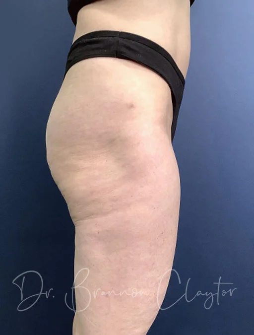 smart-liposuction-outer-thighs-47180c-after-claytor