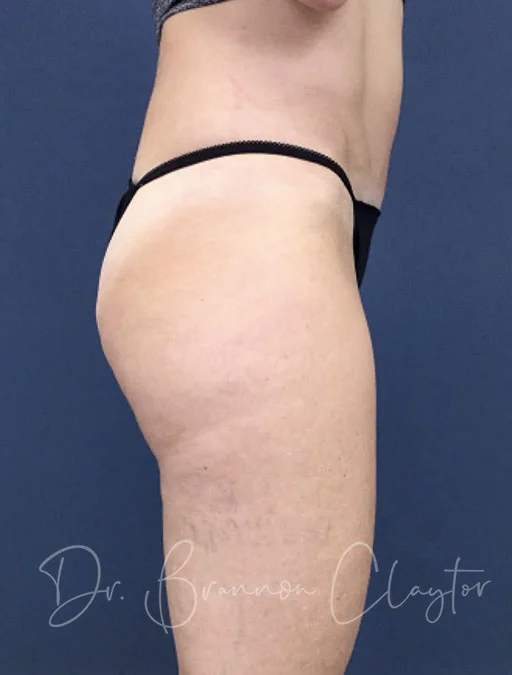 smart-liposuction-outer-thighs-47180c-claytor