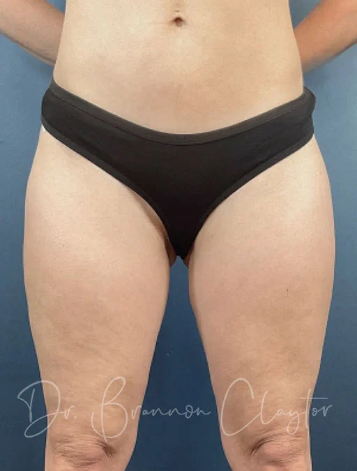 smart-liposuction-outer-thighs-50777a-after-claytor