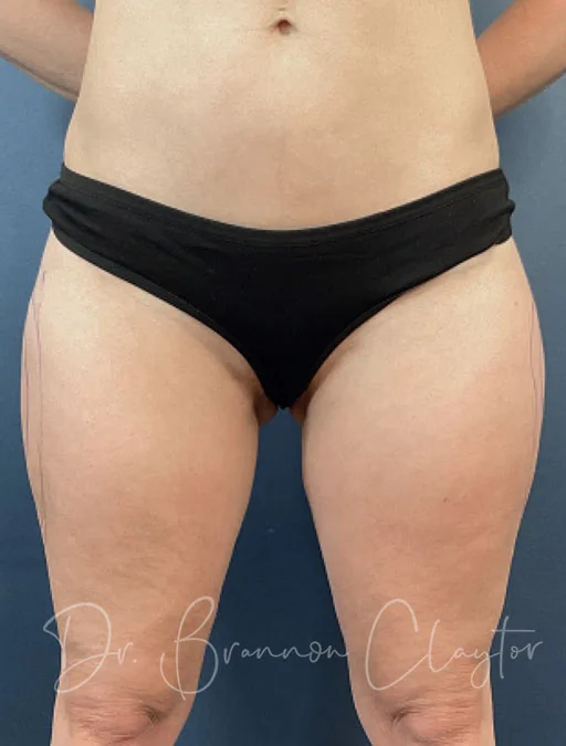 smart-liposuction-outer-thighs-50777a-before-claytor