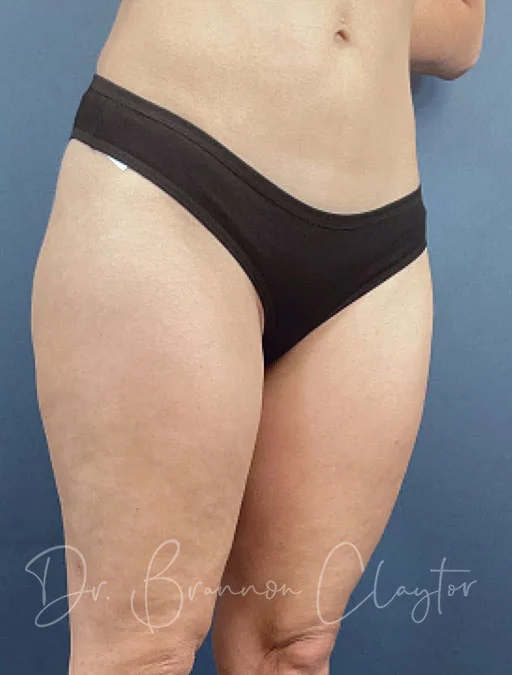 smart-liposuction-outer-thighs-50777b-after-claytor