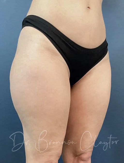 smart-liposuction-outer-thighs-50777b-before-claytor