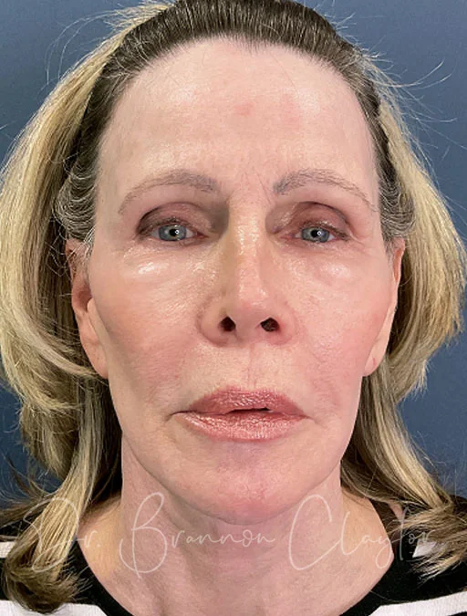 facelift-deep-plane-neck-lift-49600a-after