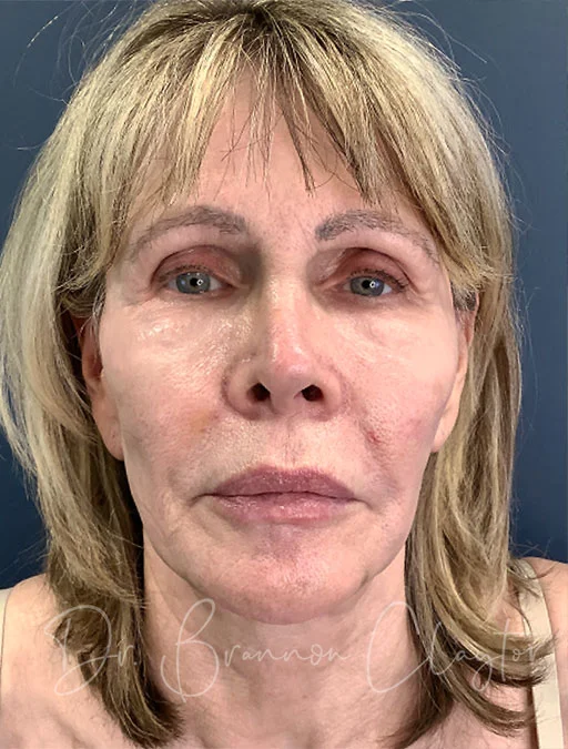 facelift-deep-plane-neck-lift-49600a-before