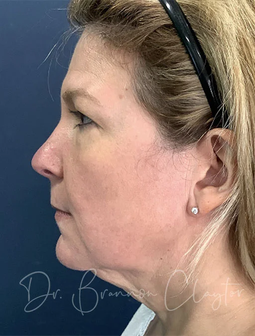 Comfort Wrap with Ear Contour Facelift Chin Lift or Neck Lift