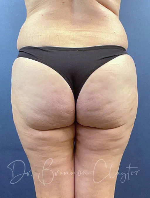 smart-liposuction-medial-thighs-buttocks-50672-d-after-claytor