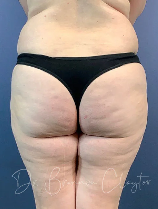 smart-liposuction-medial-thighs-buttocks-50672-d-before-claytor