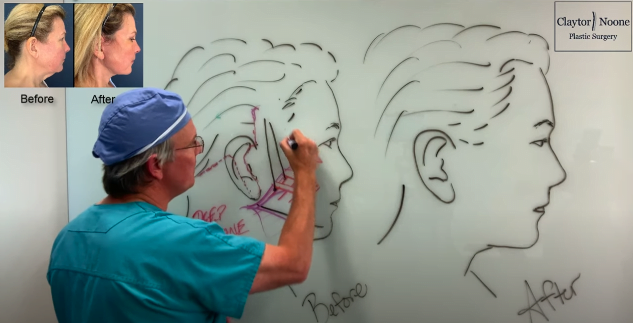 SMAS Vs Deep Plane Facelift Philadelphia Plastic Surgeon Explains The Difference With Video