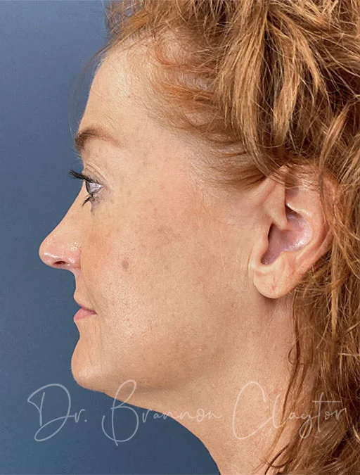 MyEllevate Neck Lift