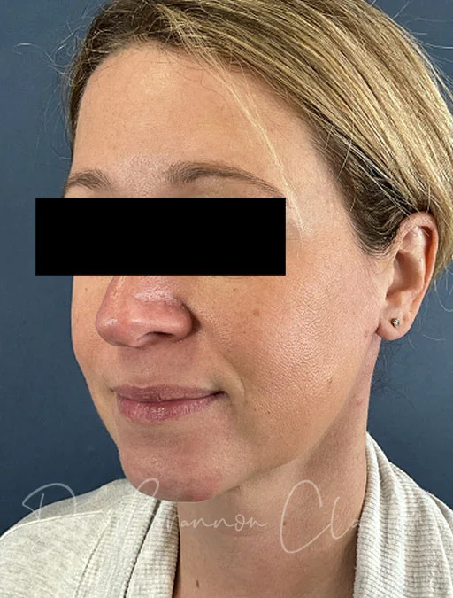 MyEllevate Neck Lift